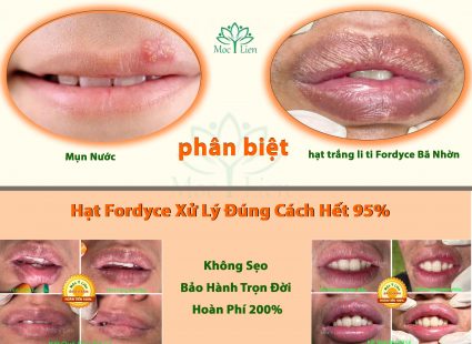 Môi bị sần sùi: Nguyên nhân và cách khắc phục hiệu quả Gallery 2