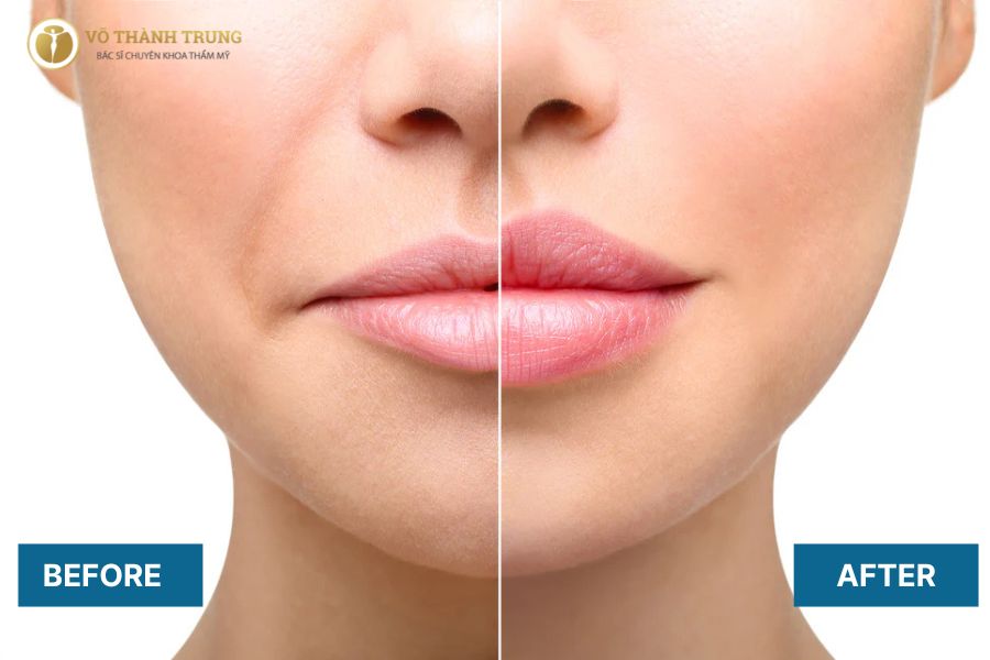 Môi Trên Vểnh Lên: Nguyên Nhân, Cách Khắc Phục và Làm Đẹp Gallery 2