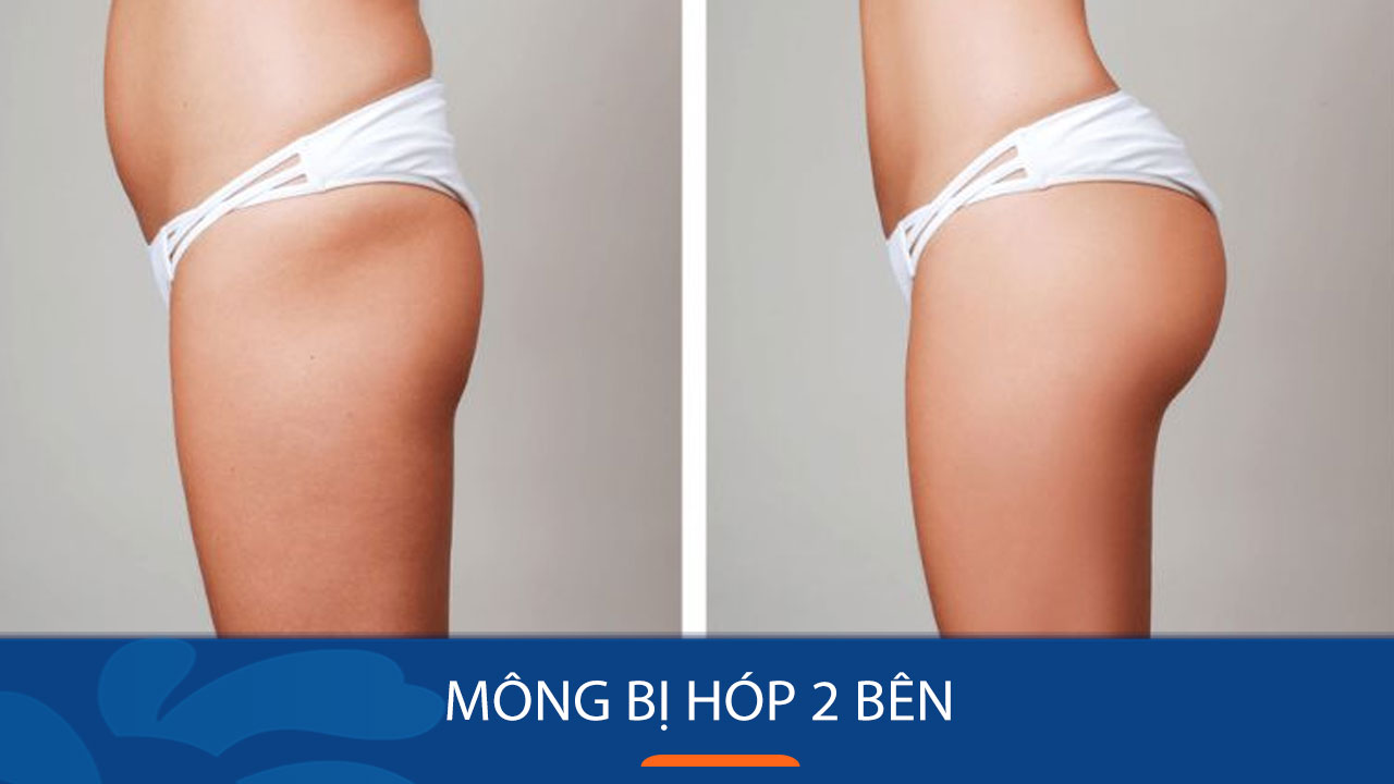 Mông Bị Lõm 2 Bên: Nguyên Nhân và Cách Khắc Phục Gallery 2