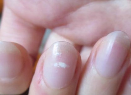 Móng Tay Đốm Trắng Là Gì? Nguyên Nhân Và Cách Khắc Phục Gallery 2