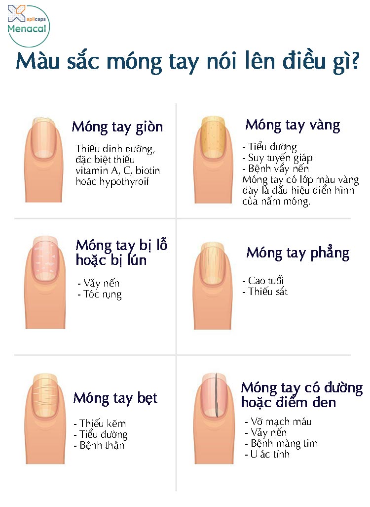 Móng Tay Có Màu Trắng Đục: Nguyên Nhân Và Cách Khắc Phục Gallery 2