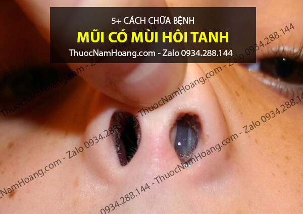 Cánh Mũi Có Mùi Hôi: Nguyên Nhân và Cách Khắc Phục Gallery 2