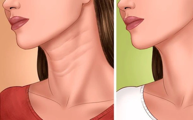 Bị Ngấn Ở Cổ: Nguyên Nhân, Cách Khắc Phục và Phòng Ngừa Gallery 2