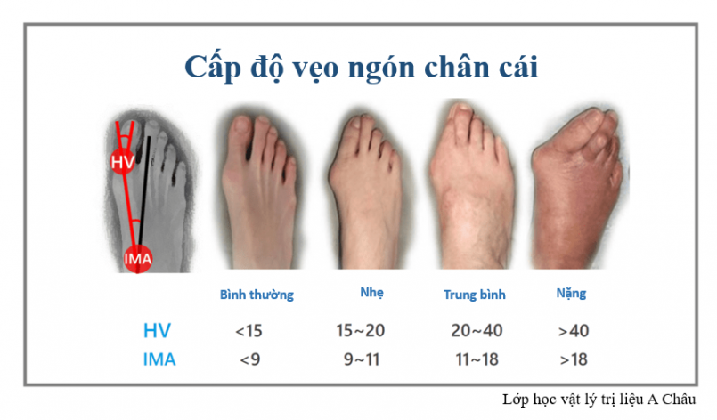 Ngón Chân Xòe Ra: Nguyên Nhân Và Cách Khắc Phục Gallery 2