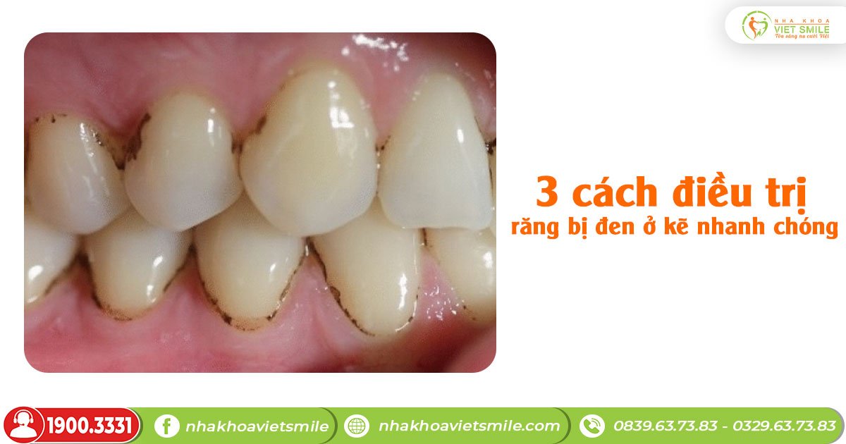 Răng bị đen ở kẽ: Nguyên nhân và cách khắc phục Gallery 2
