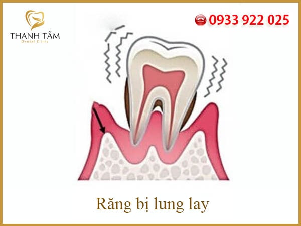 Răng lung lay làm sao để chắc lại? Gallery 2