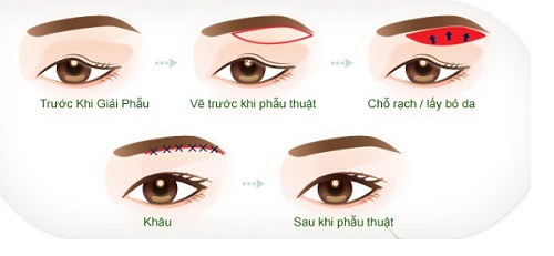 Rũ Mắt Là Gì? Nguyên Nhân Và Cách Khắc Phục Gallery 2