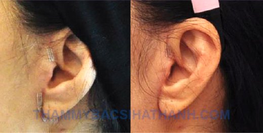 Tai Cụp Vào Trong: Nguyên Nhân, Cách Khắc Phục & Khi Nào Cần Đi Khám Gallery 2