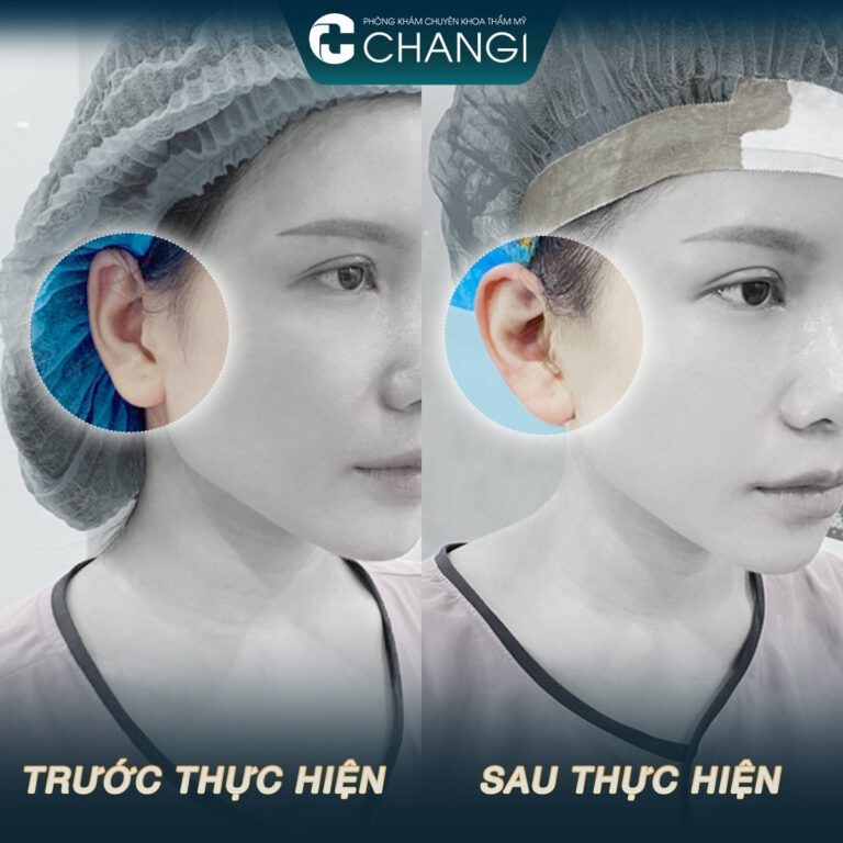 Tai Vểnh Ra Sau: Nguyên Nhân, Khắc Phục Và Những Điều Cần Biết Gallery 2