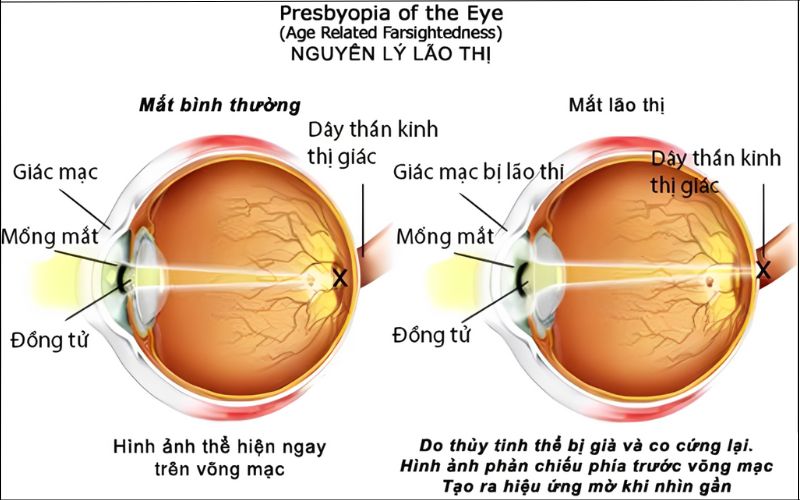 Cách Khắc Phục Tật Mắt Lão
