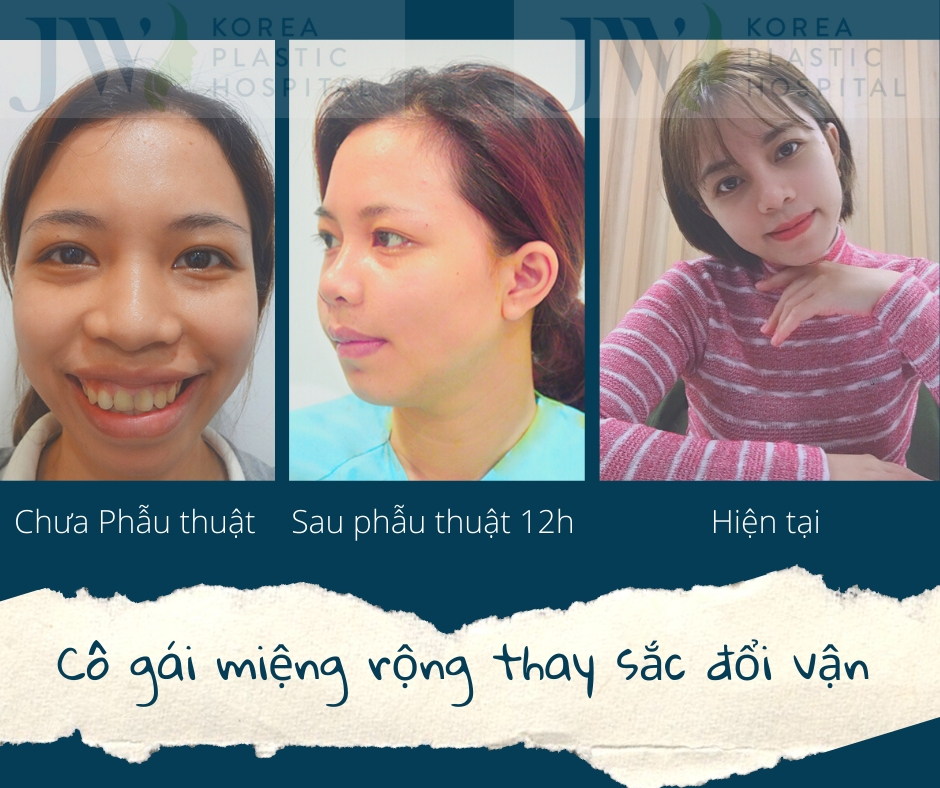 Con Gái Mồm Rộng: Nguyên Nhân và Cách Khắc Phục Gallery 2