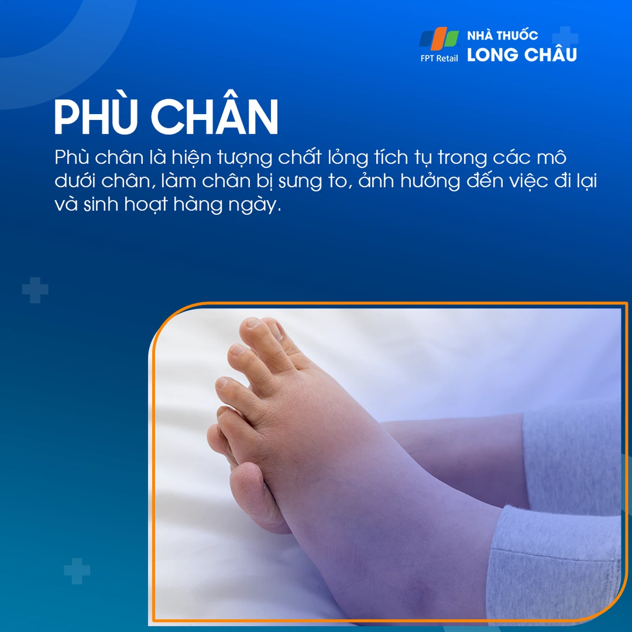 Ngấn Chân Bên 2 Bên 1 Gallery 2