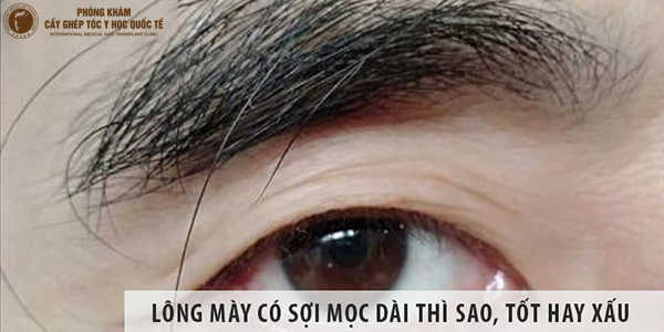Vài Sợi Lông Mày Mọc Dài Bất Thường: Nguyên Nhân Và Cách Khắc Phục Gallery 2