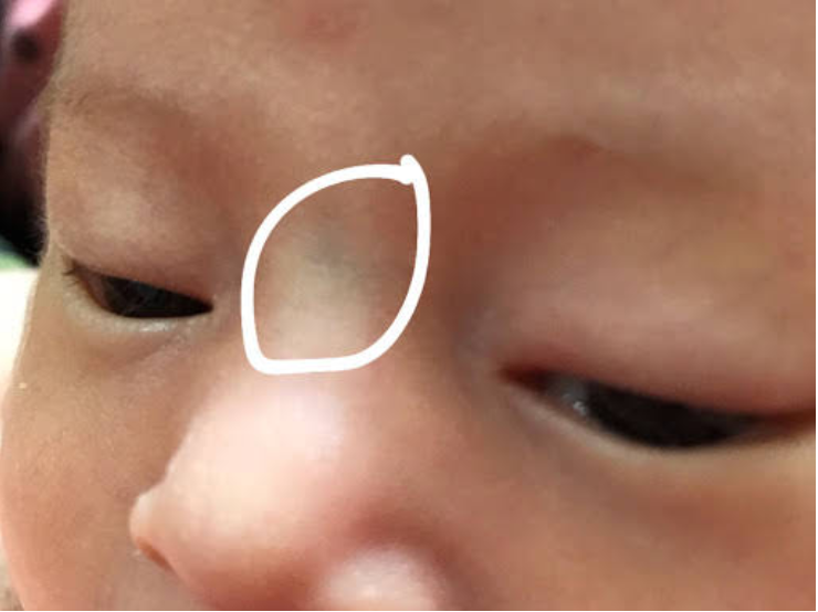 Vết Lằn Ngang Trên Sống Mũi: Nguyên Nhân Và Cách Khắc Phục Gallery 2