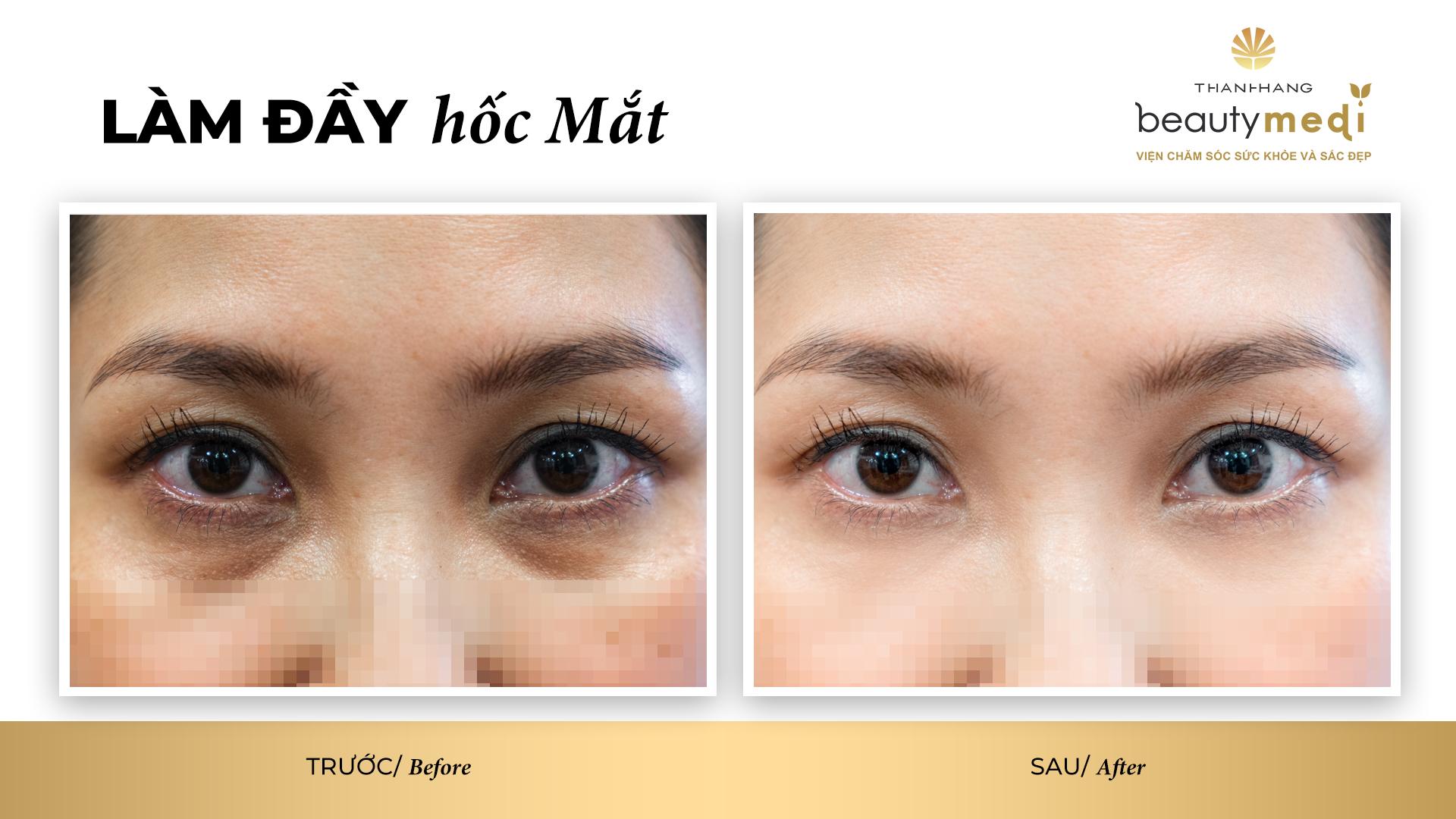 Cách Làm Đầy Hốc Mắt Tự Nhiên