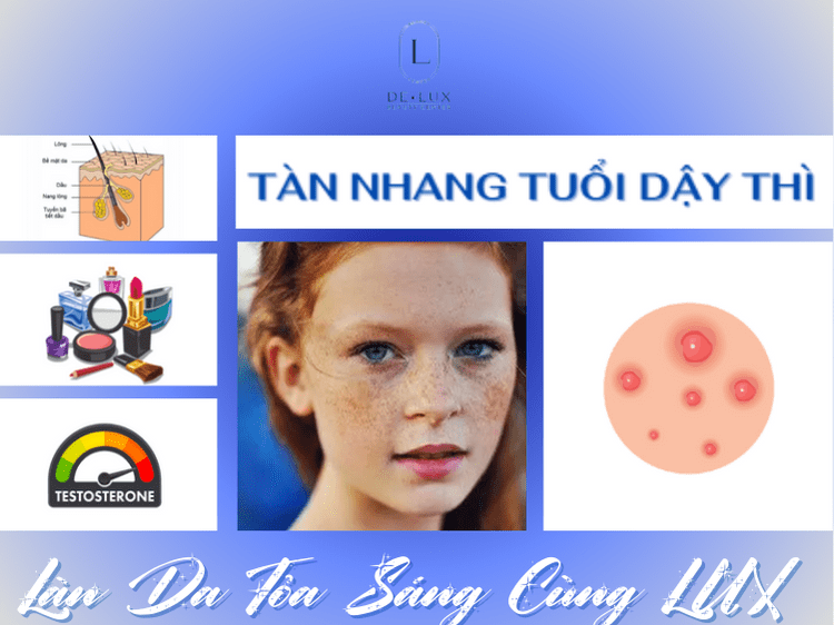 Cách Làm Hết Tàn Nhang Ở Tuổi Dậy Thì
