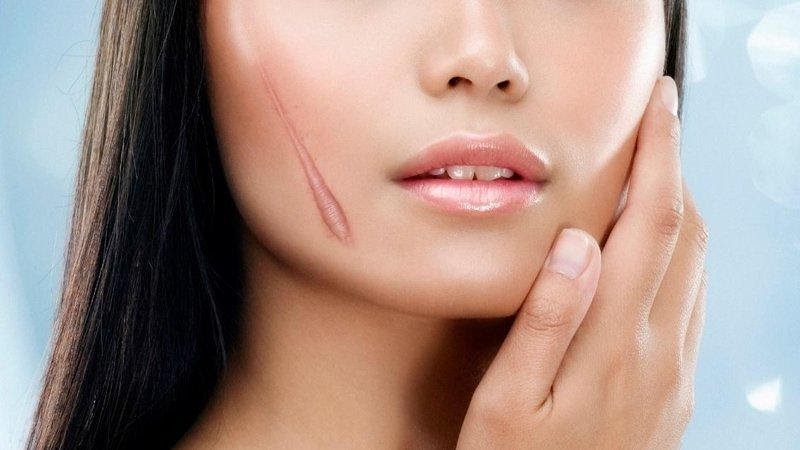 Cách Làm Liền Sẹo Trên Mặt Hiệu Quả