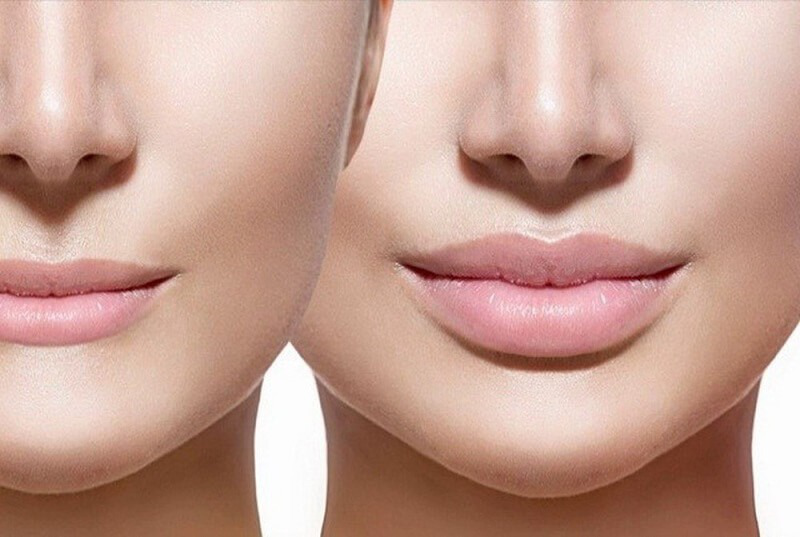 Cách Làm Môi Bớt Trề