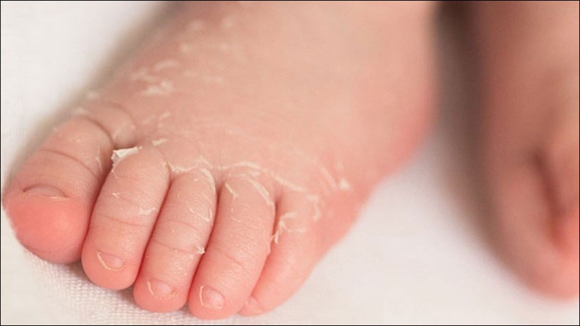 Cách Làm Sạch Da Cáy Ở Trẻ Sơ Sinh