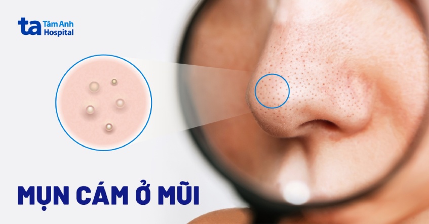 Mụn cám ở mũi làm sao hết? Gallery 1