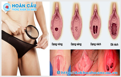 Cách Nhận Biết Màng Trinh Dày Hay Mỏng