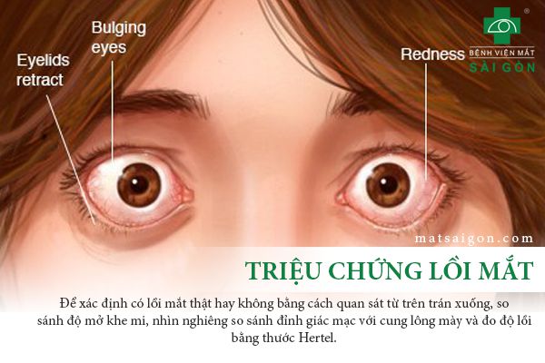 Cách Nhận Biết Mắt Bị Lồi