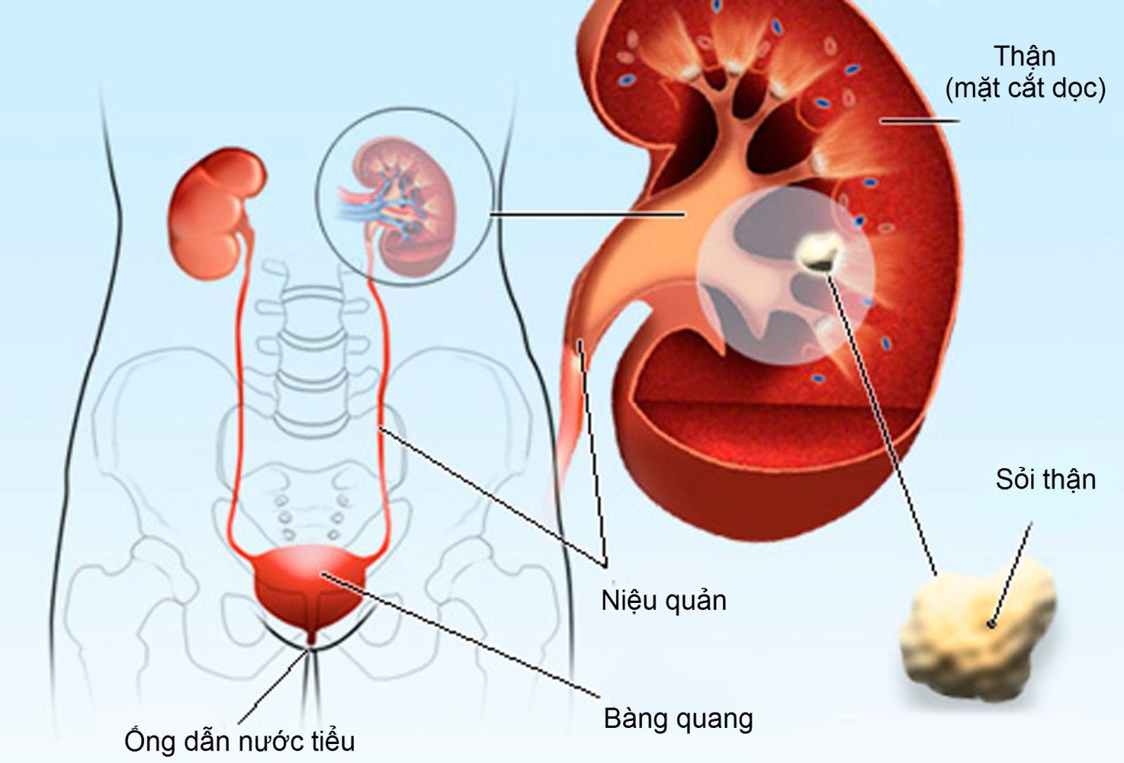 Nguyên Nhân Gây Sỏi Thận: Giải Đáp Thắc Mắc Của Bạn Gallery 2