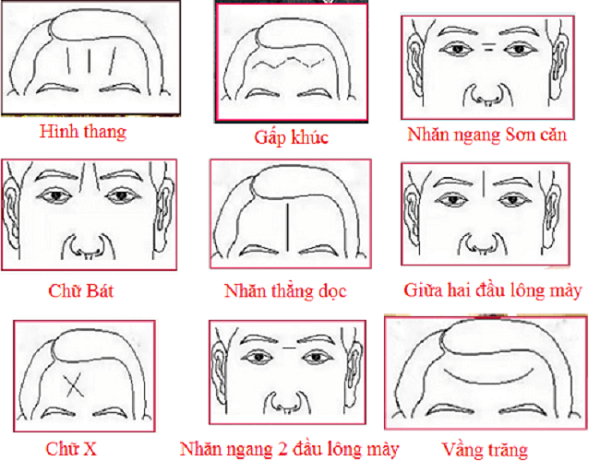 Nếp nhăn trên trán đàn ông: Nguyên nhân, cách phòng ngừa và điều trị Gallery 2