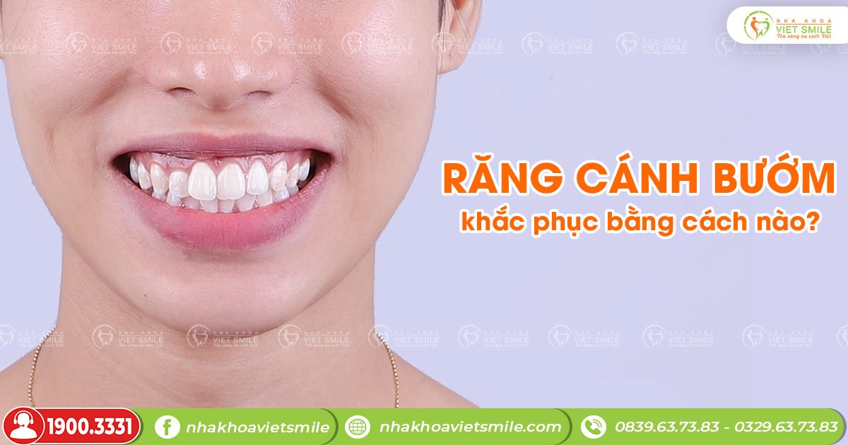 Răng Cánh Bướm Đẹp Gallery 2