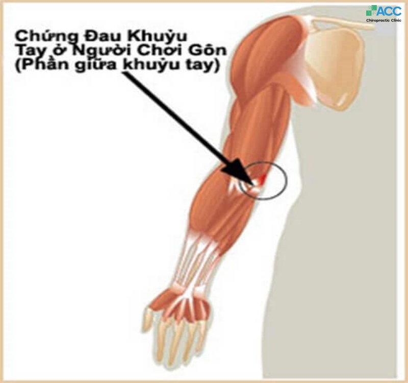 Khủy Tay Hay Khuỷu Tay? Gallery 2