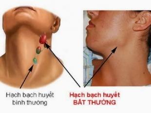 Sưng hay Xưng? Sự khác biệt và cách sử dụng đúng Gallery 1