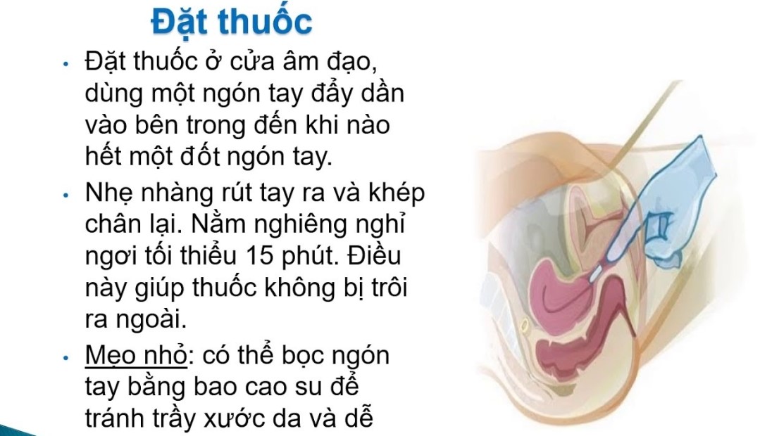 Viên Đặt Se Khít Thái Lan: Giúp Se Khít, Săn Chắc Vùng Kín Gallery 2