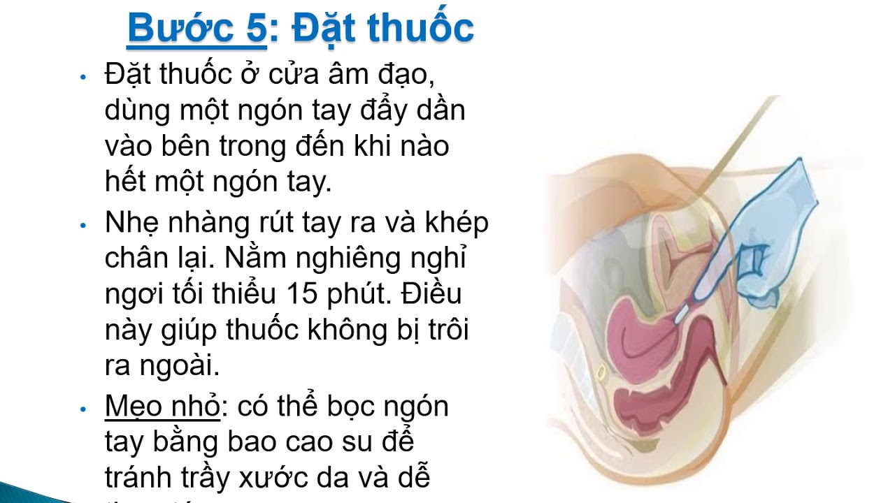 Viên Nhét Âm Đạo Gallery 1