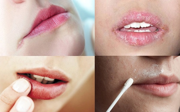 Cách Trị Chốc Mép Hiệu Quả