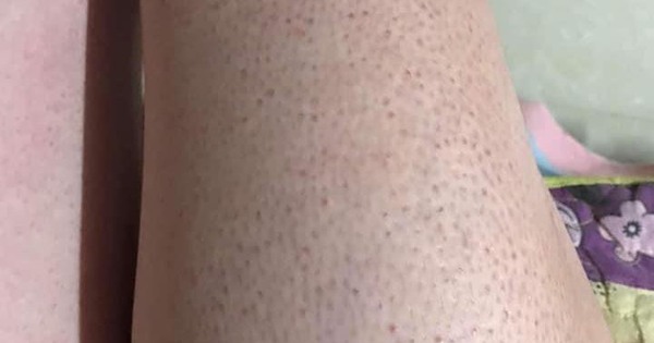 Cách Trị Dày Sừng Nang Lông Hiệu Quả Tại Nhà Và Bác Sĩ