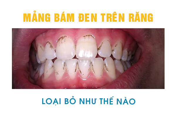 Cách Trị Đốm Đen Trên Răng Tại Nhà Gallery 2