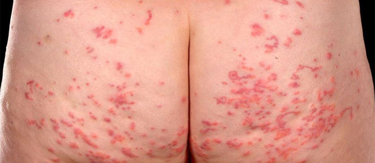 Cách Trị Ghẻ Ở Mông Tại Nhà