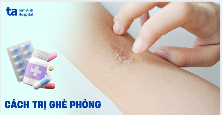 Cách Trị Ghẻ Phỏng Hiệu Quả