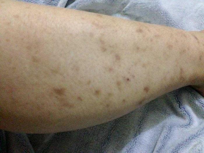 Cách Trị Ghẻ Thâm Ở Chân