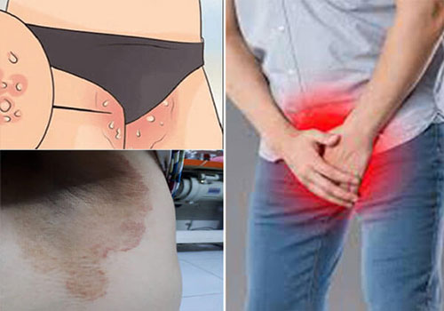 Cách Trị Hăm Da Ở Người Lớn