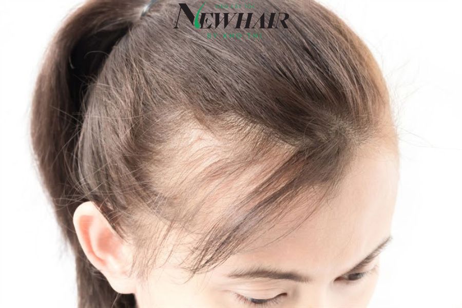 Cách Trị Hói Trán Ở Nữ Gallery 2