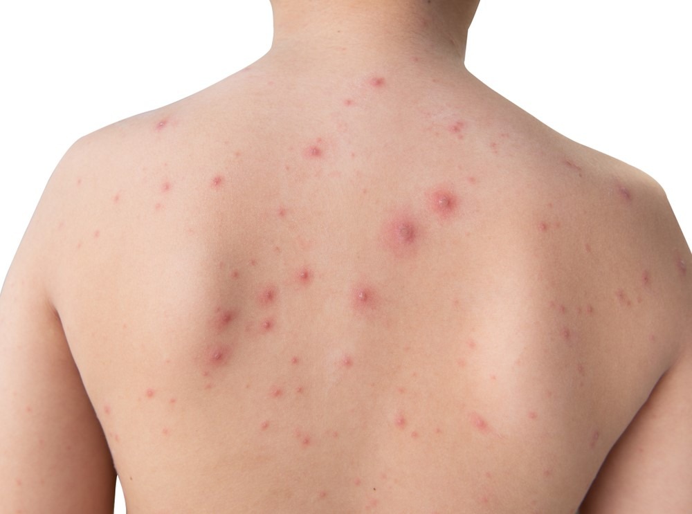Cách Trị Nổi Trái Rạ Hiệu Quả