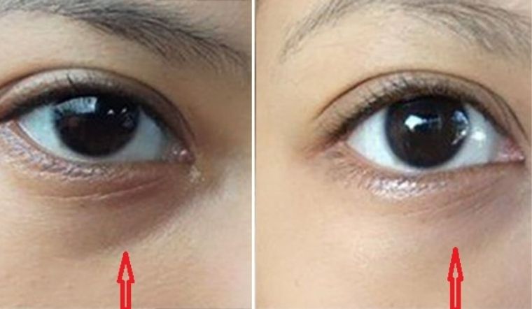 Cách Trị Quầng Thâm Mắt Trong 1 Tuần Gallery 1