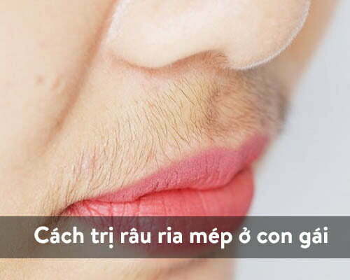 Cách Trị Ria Mép Hiệu Quả và An Toàn