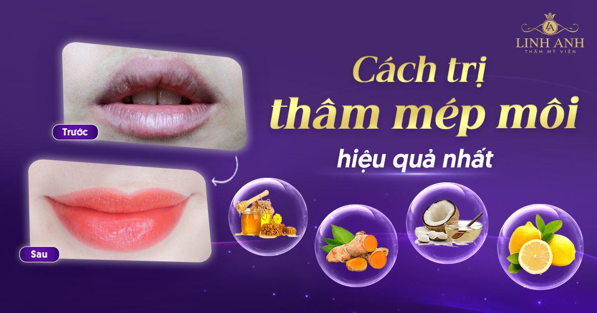 Trị thâm mép môi hiệu quả, an toàn tại nhà và spa Gallery 2