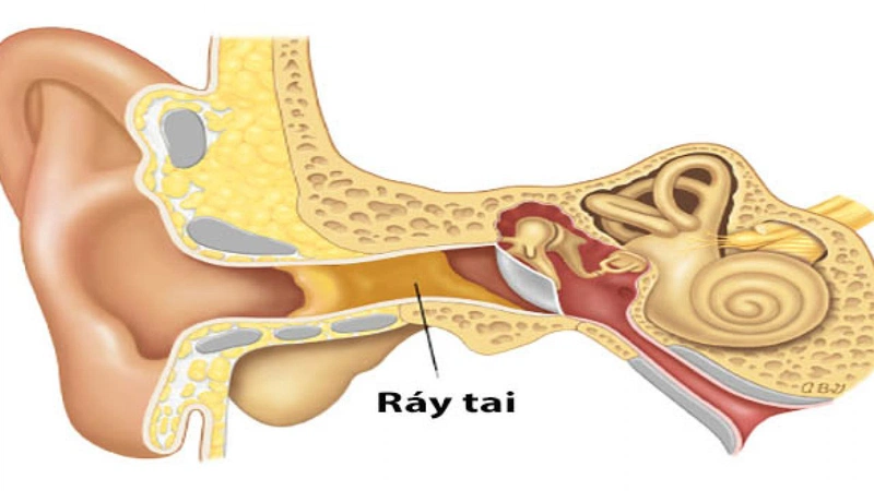 Cách Tự Lấy Ráy Tai An Toàn Và Hiệu Quả