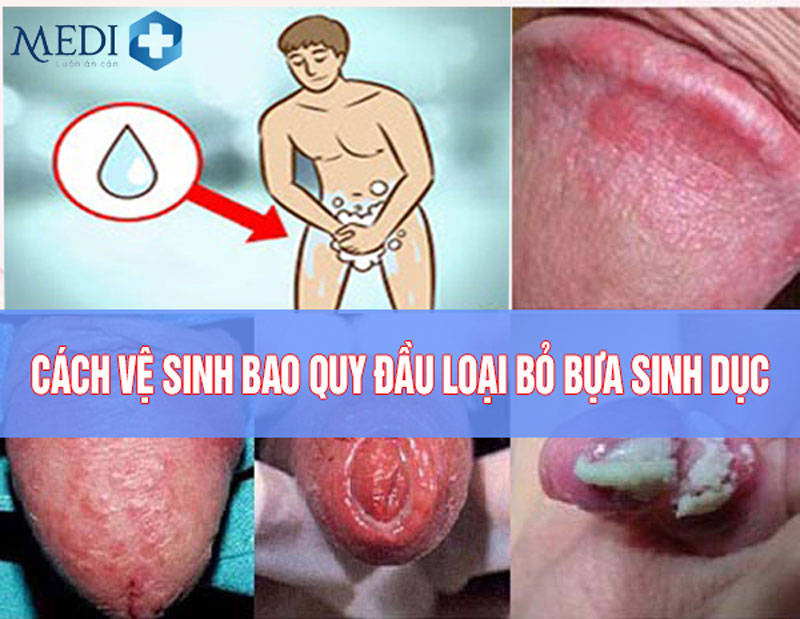 Cách Vệ Sinh Bựa Sinh Dục