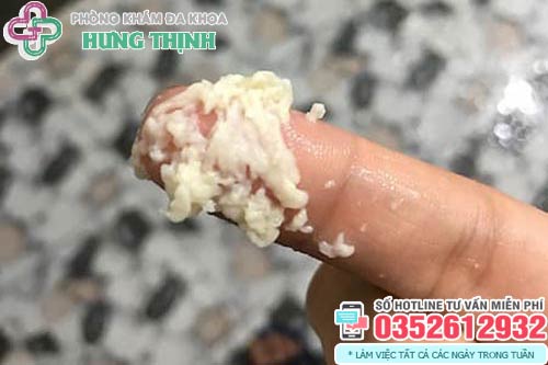 Bã trắng ở vùng kín: Nguyên nhân và cách xử lý Gallery 2