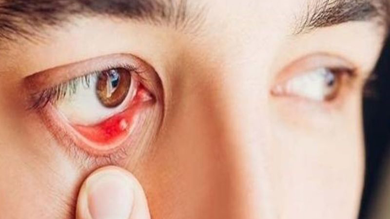 Dưới mí mắt có hạt trắng là bệnh gì? Gallery 2