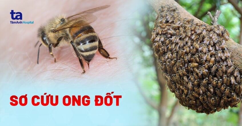 Bị ong ruồi đốt có nguy hiểm không? Gallery 2